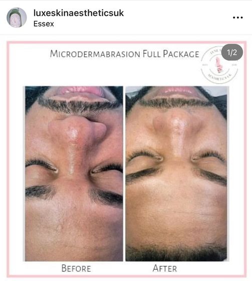 Microdermabrasion full package: before and after