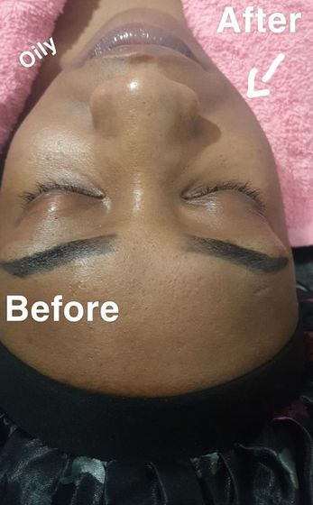 Microneedling package, one session: before and after
