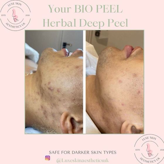 Herbal deep peel: before and after