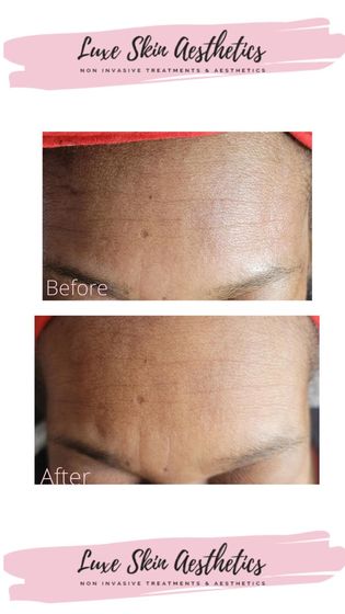 Oily skin rebalanced: before and after