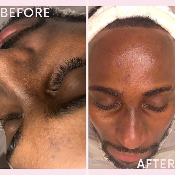 Eye and cheek area: before and after