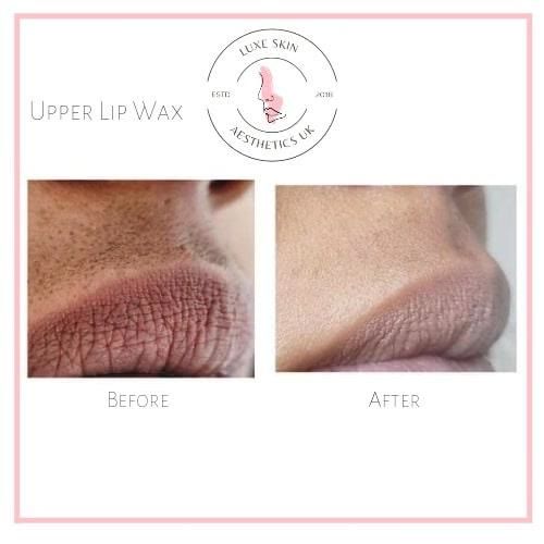 Upper lip wax: before and after